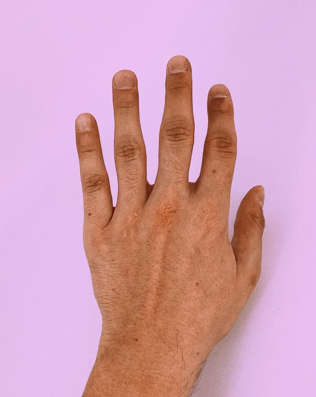 Hand orthopaedic treatment